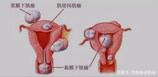 子宫肌瘤怎么治最好？