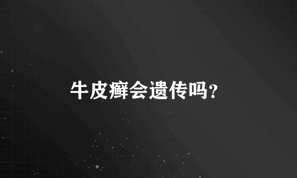 牛皮癣会遗传吗？