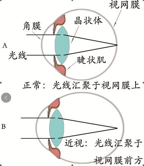 怎样使近视眼慢慢恢复？