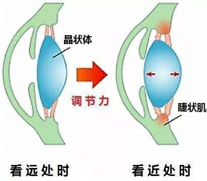 怎样使近视眼慢慢恢复？