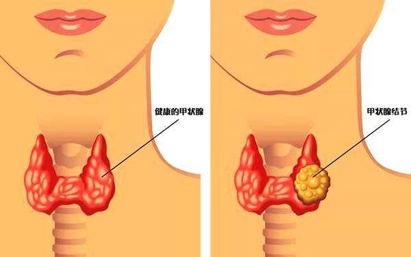 甲状腺结节的起因?