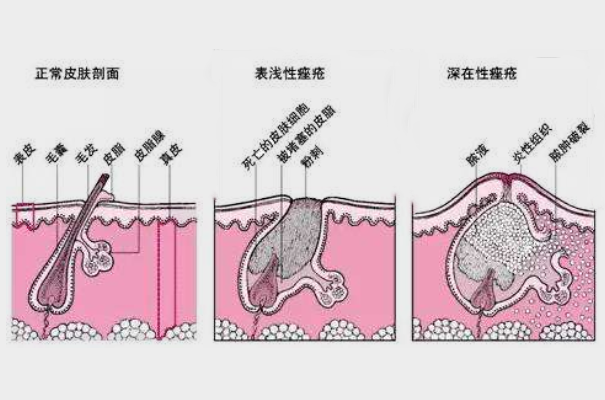 为什么青春期会长痘痘