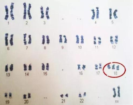 21号染色体18号染色体13号染色体分别是什么？