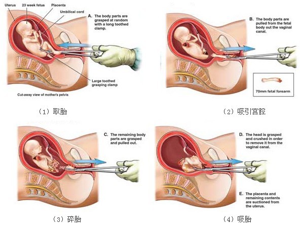 双腔减压无痛人流的手术对比