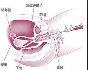 输卵管通而不畅最好的治疗方法